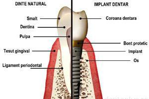 Implant dentar