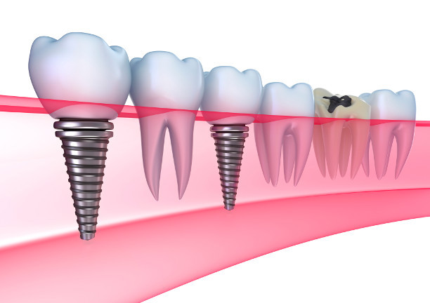 Implant dentar