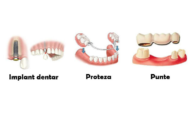 Protetică dentară